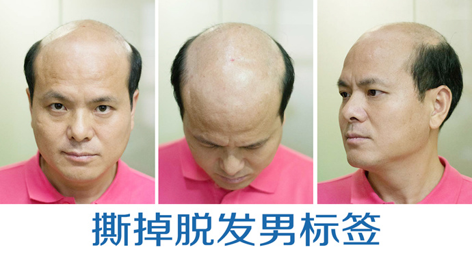 男士隱形補發 \