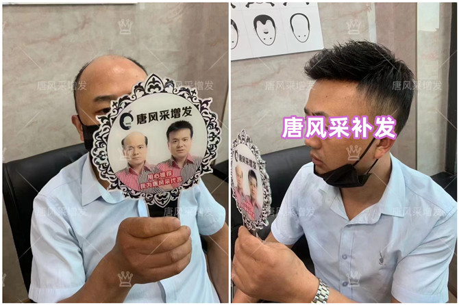 男士隱形補發 \