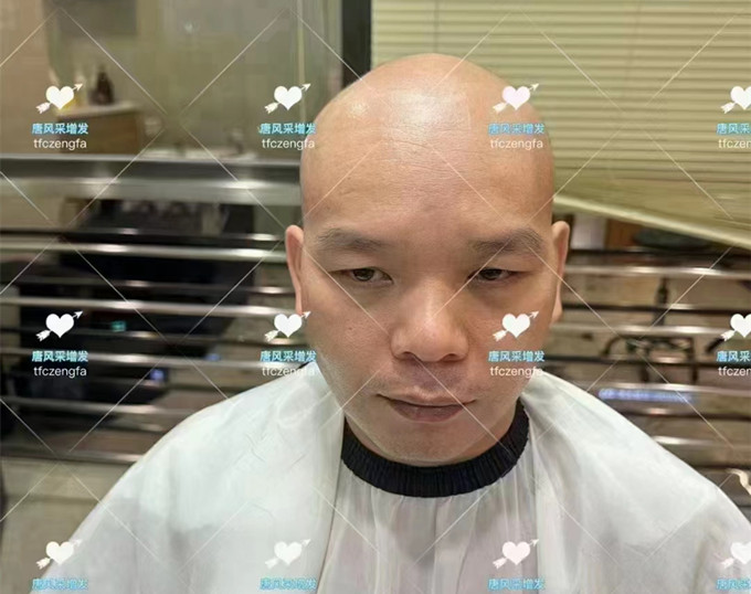 頭頂頭發稀疏 \