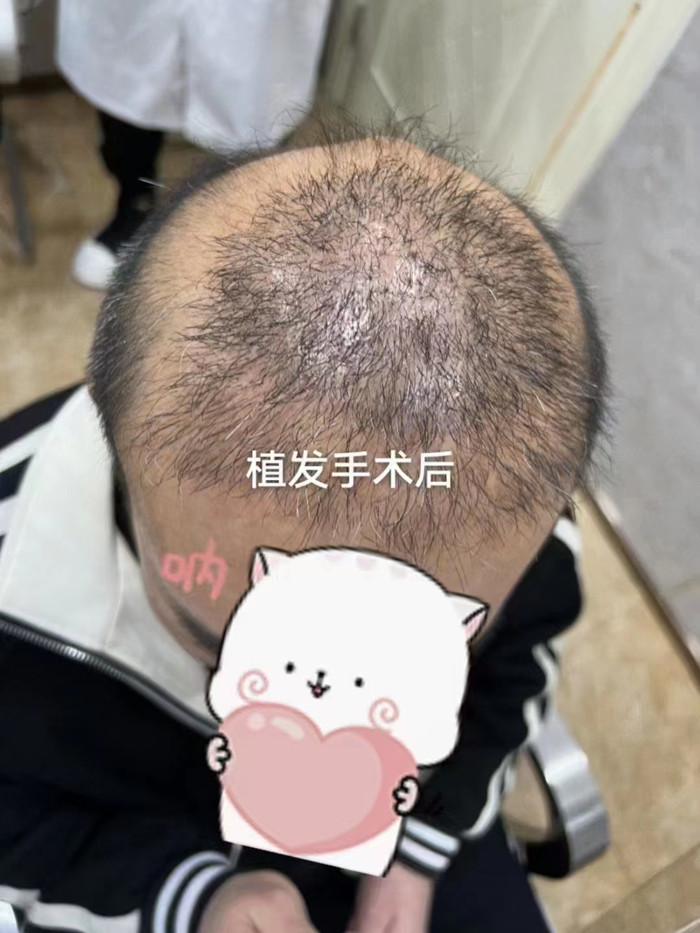 脫發做補發多少錢 \