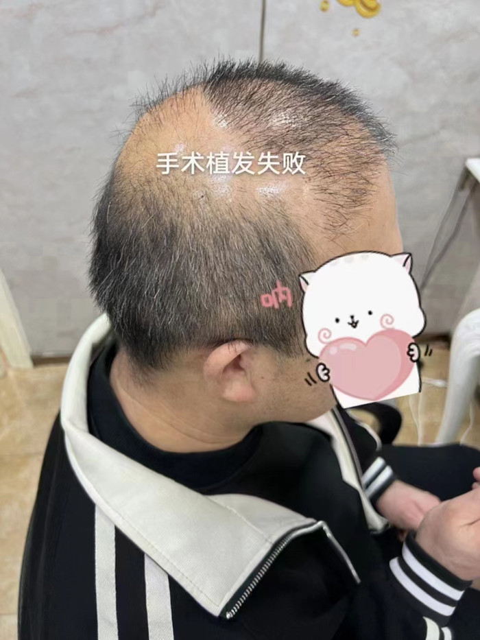 脫發做補發多少錢 \