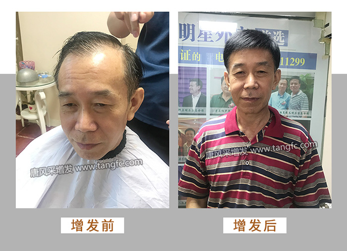 脂溢性脫發 \