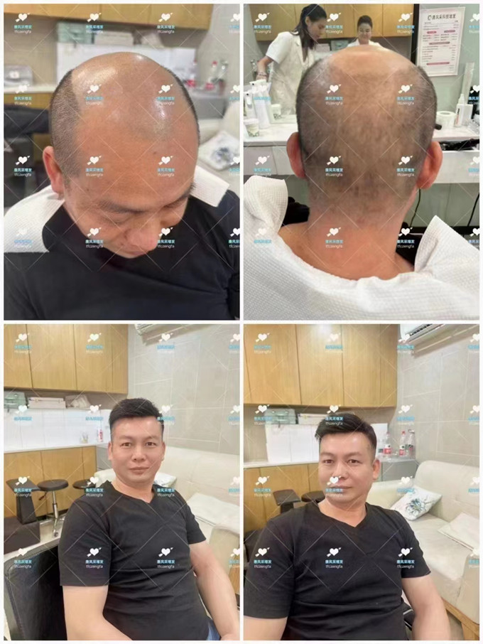 變高的發際線 \