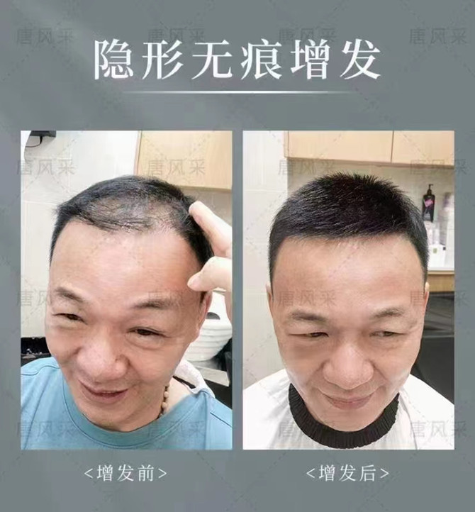 變高的發際線 \