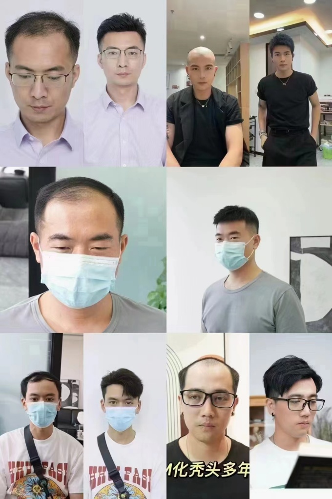 溫州隱形補發假發 \