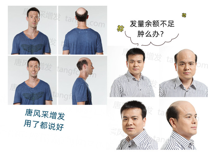 頭頂假發片 \