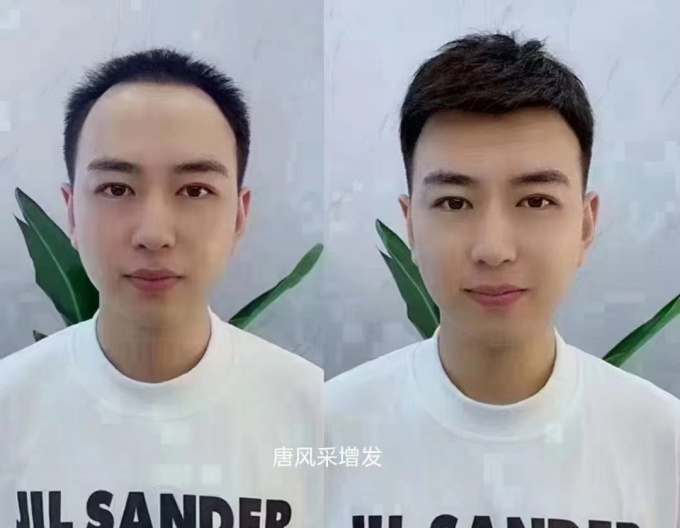 頭頂假發片 \