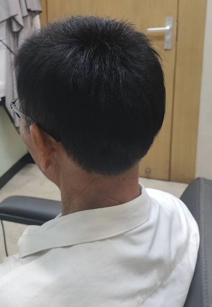 稀疏頭發 \