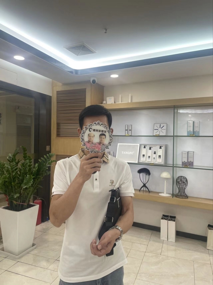 稀疏頭發 \