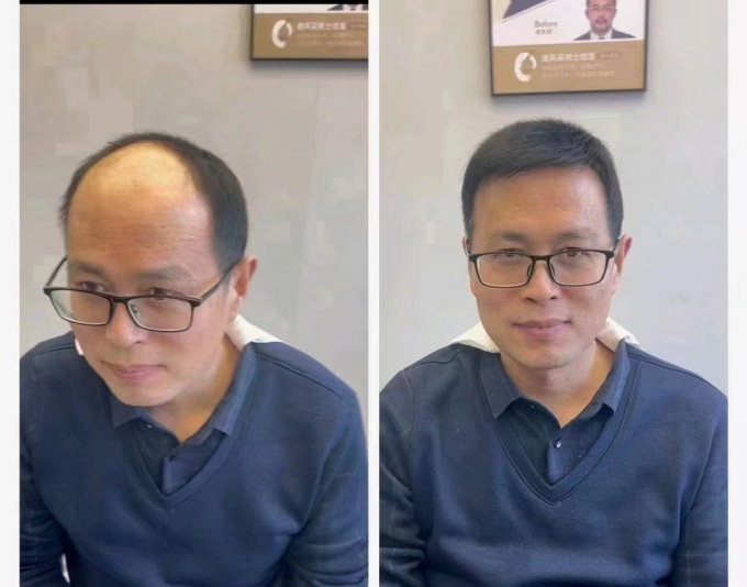 稀疏頭發 \